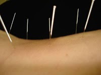 Harpenden Acupuncture 722616 Image 0